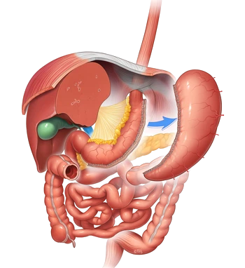 Bariatric surgery illustration showing stomach size reduction by the Best Bariatric Surgeon In Vadodara