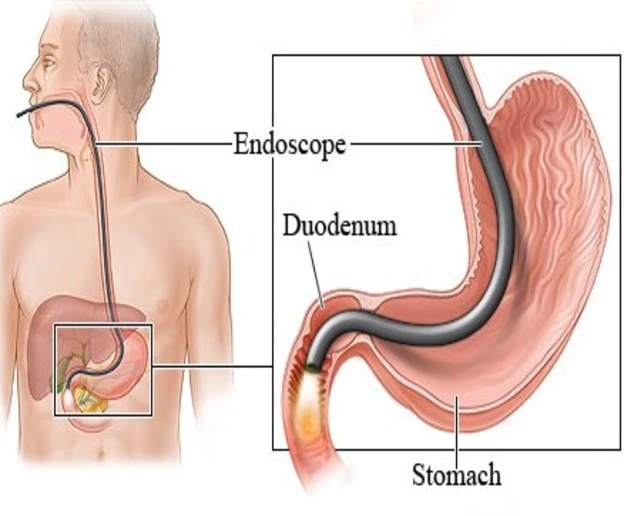 Endoscopy procedure illustration showing a stomach examination with an endoscope by the Best Endoscopy Specialist in Vadodara