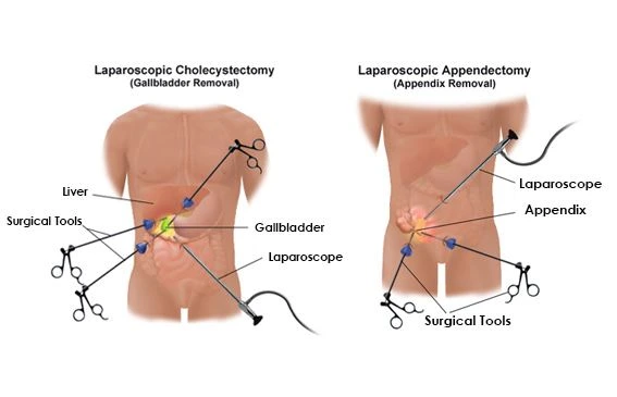 Laparoscopic surgery diagram showing gallbladder and appendix removal by the Best Laparoscopic Surgeon in Vadodara